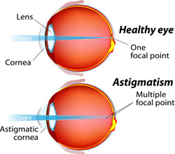 Astigmatism Diagram